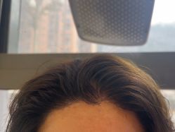 -碧莲盛·不剃发植发