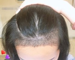 -大麦微针植发丨全国连锁