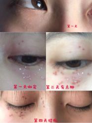 -美丽人生祛斑扁平疣汗管瘤中心