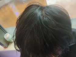 -碧莲盛·不剃发植发