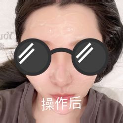 体验后-海涛医疗美容·面部抗衰·注射美鼻