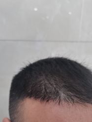 -碧莲盛·不剃发植发