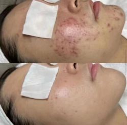 -美丽人生祛斑扁平疣汗管瘤中心