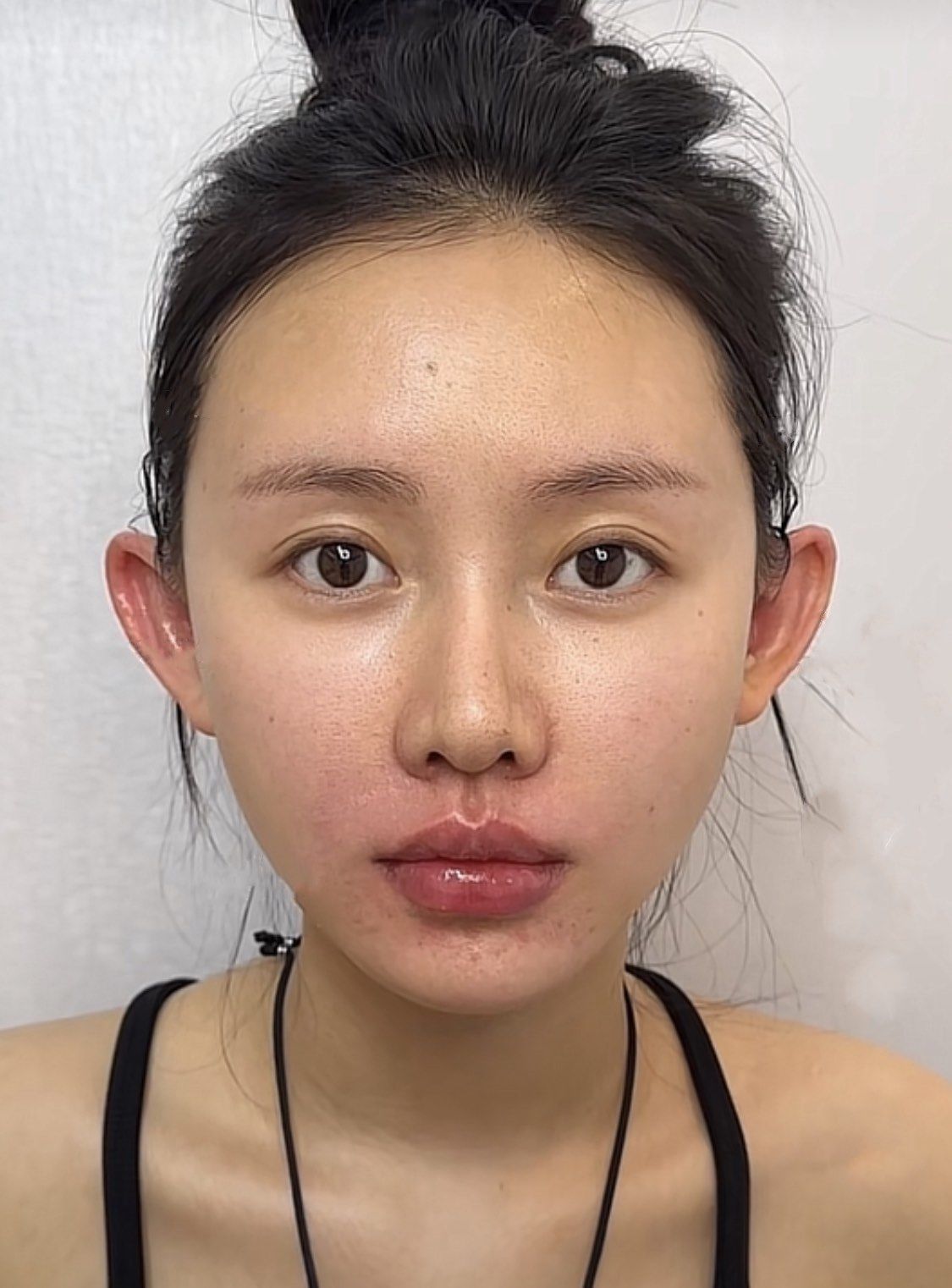 精灵耳注射完成显幼态脸感了