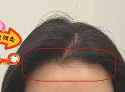 -大麦微针植发全国连锁