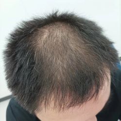 -大麦微针植发全国连锁