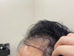 -碧莲盛·不剃发植发