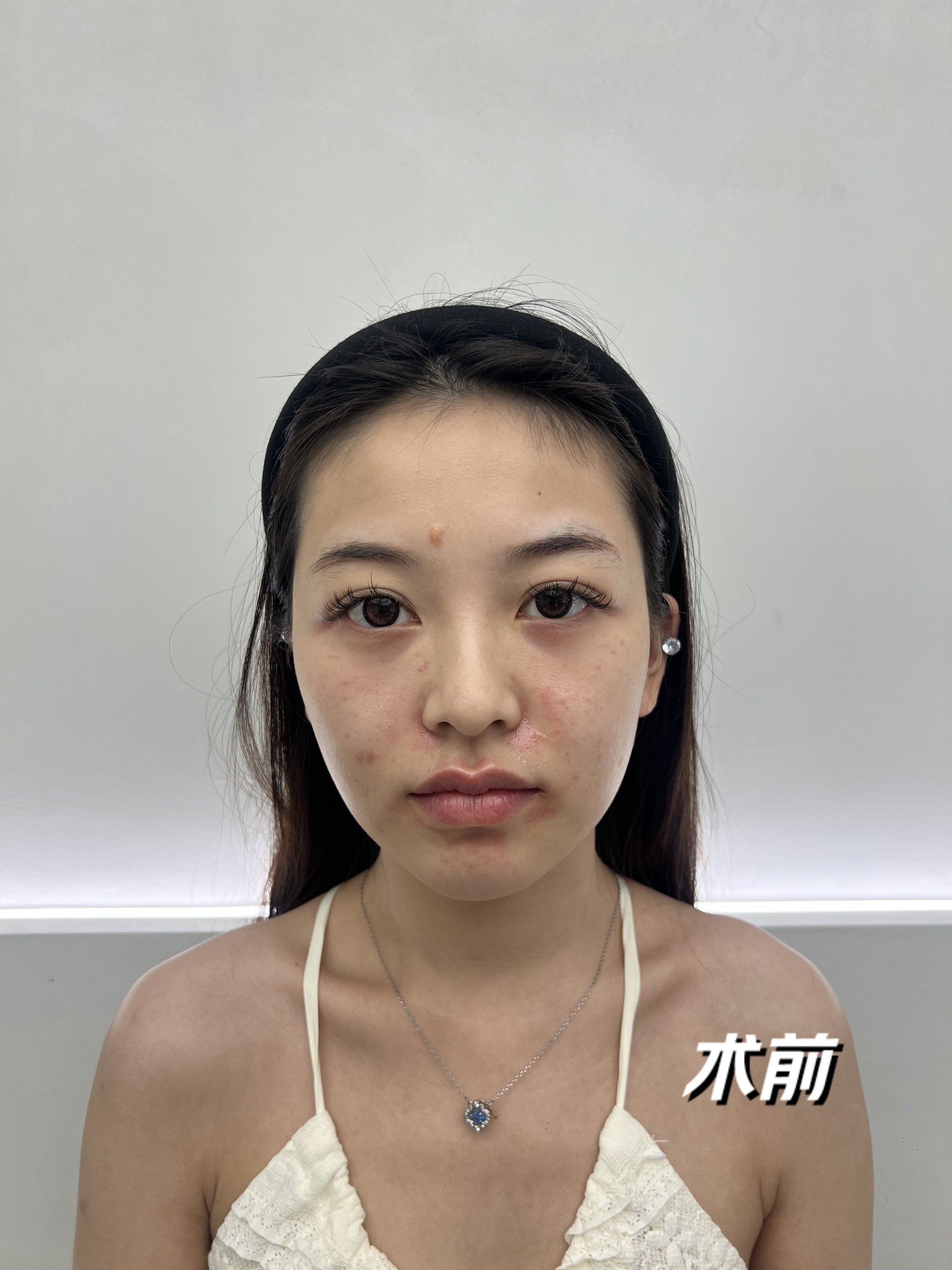 公主玻尿酸外轮廓重塑,术后3天yyds