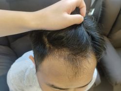 -碧莲盛·不剃发植发