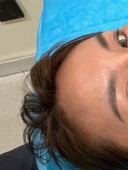 体验前-海涛医疗美容·面部抗衰·注射美鼻