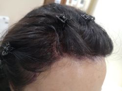 -碧莲盛·不剃发植发