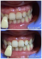 光SPA美白牙齿-光SPA科技美肤