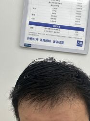 -大麦微针植发丨全国连锁