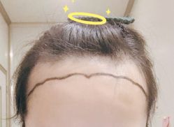 -大麦微针植发全国连锁