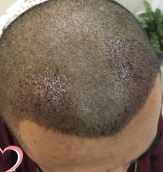 -大麦微针植发丨全国连锁