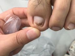 -世龙世家灰指甲·甲沟炎·跖疣护理·修脚(东江湾路店)