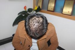 -大麦微针植发丨全国连锁