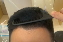 -大麦微针植发丨全国连锁