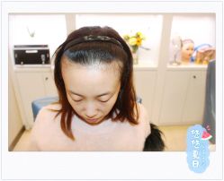 点击看大图 体验后-大麦微针植发全国连锁