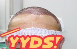 -大麦微针植发丨全国连锁