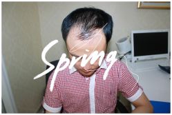 体验后-大麦微针植发全国连锁