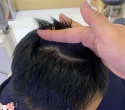 -大麦微针植发丨全国连锁