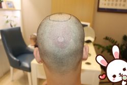 -大麦微针植发丨全国连锁