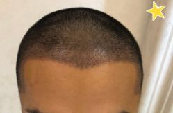 -大麦微针植发丨全国连锁