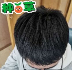 -大麦微针植发丨全国连锁