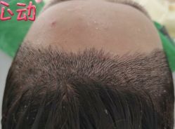 -大麦微针植发丨全国连锁