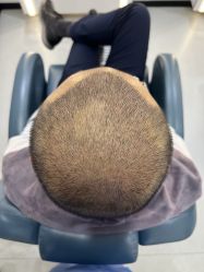 -大麦微针植发全国连锁