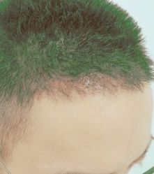 -大麦微针植发丨全国连锁