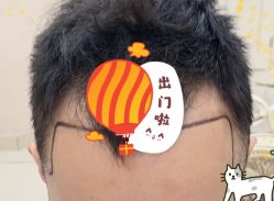 -大麦微针植发全国连锁