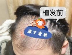 -大麦微针植发全国连锁