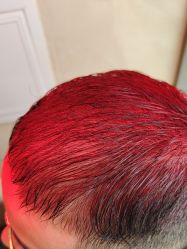 -碧莲盛·不剃发植发