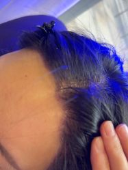 -碧莲盛·不剃发植发