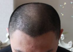 -大麦微针植发丨全国连锁