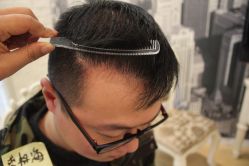 点击看大图 -大麦微针植发丨全国连锁