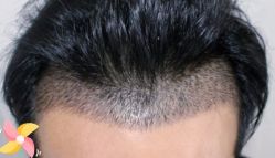 -大麦微针植发丨全国连锁