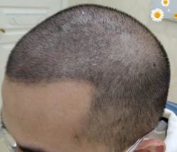 -大麦微针植发丨全国连锁