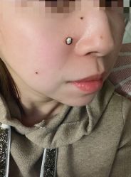 -北京美痣堂古方祛痣斑疣瘊