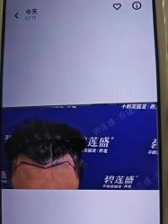 -碧莲盛·不剃发植发
