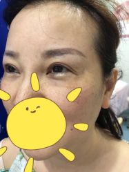 体验前-郡艺医疗美容·微整·眼鼻吸脂