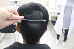 -大麦微针植发丨全国连锁