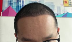-大麦微针植发丨全国连锁