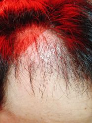 -碧莲盛·不剃发植发