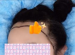 -大麦微针植发全国连锁