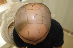 -大麦微针植发丨全国连锁