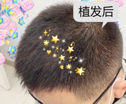 -大麦微针植发全国连锁