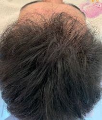 -大麦微针植发丨全国连锁